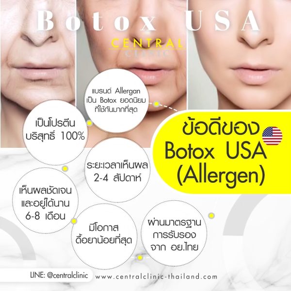 Botox USA 100 Units