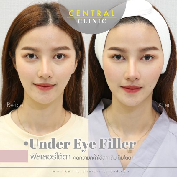 Filler High End 1 CC