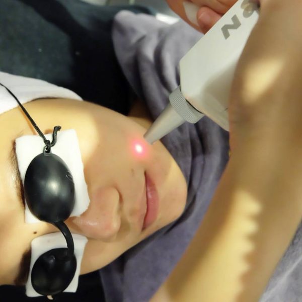 Whitening Expert Laser 1 ครั้ง