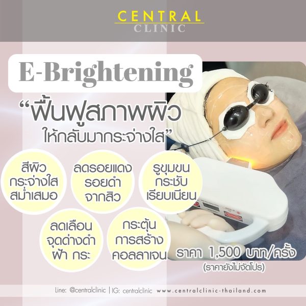 E-Brightening IPL
