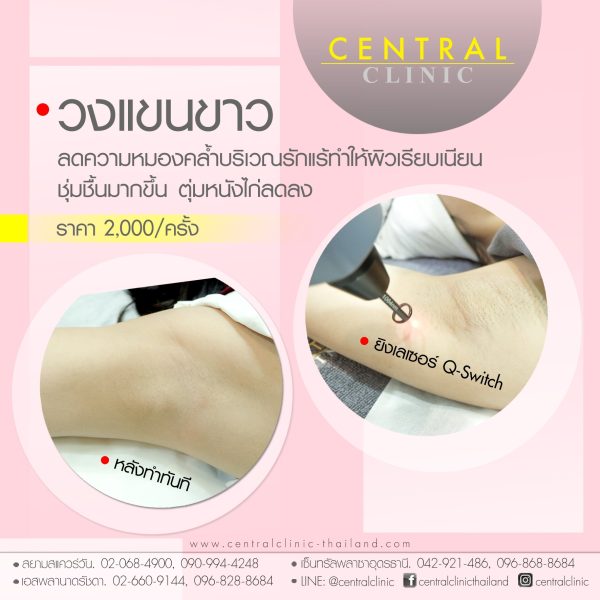วงแขนขาว