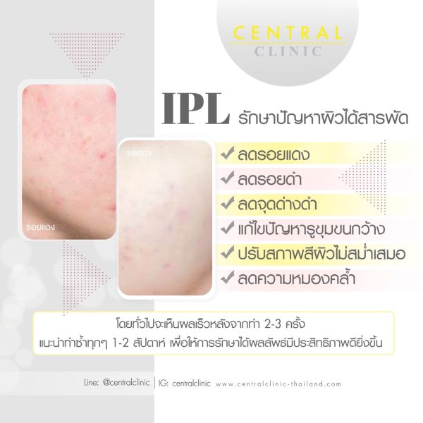 IPL