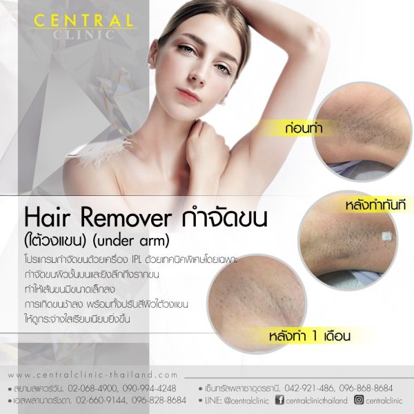 โปรแกรมกำจัดขนรักแร้  (Hair Remove)
