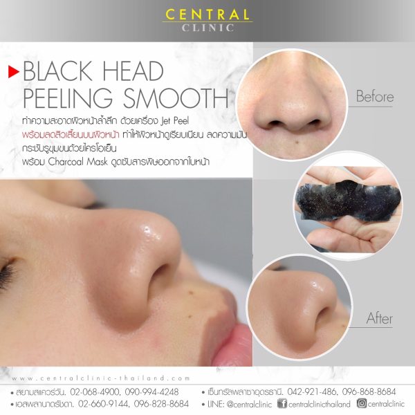 Black Head Peeling Smooth