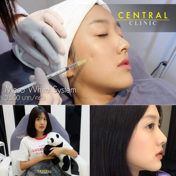 Meso White System 1 ครั้ง