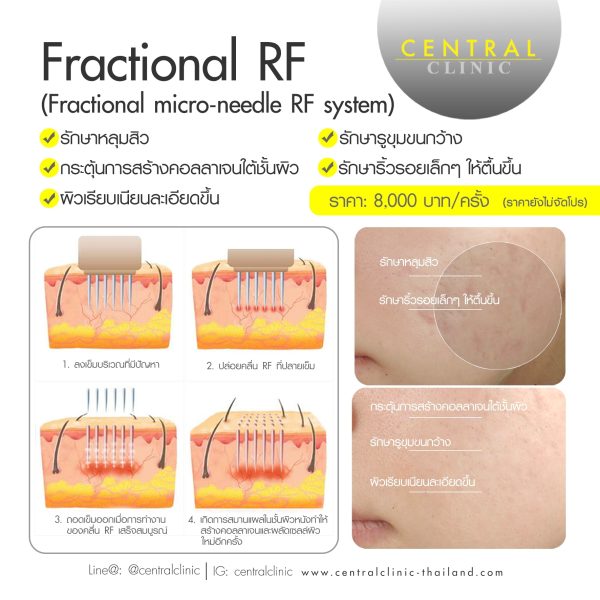 Fractional RF  รักษาหลุมสิว ซื้อ 1 แถม 1