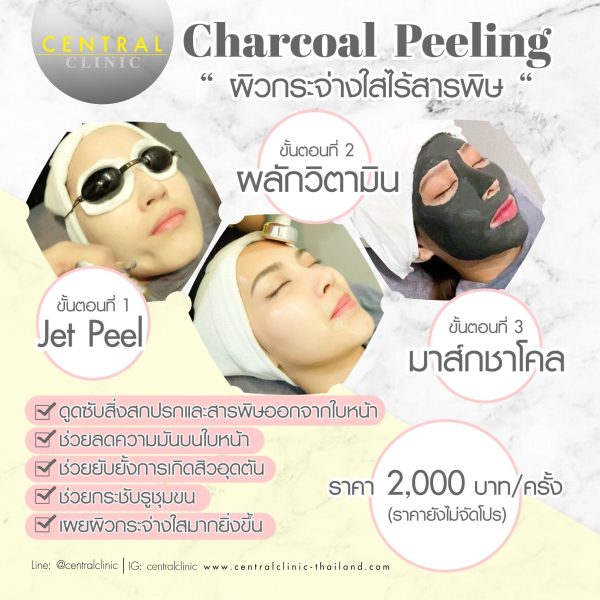 Charcoal Peeling Treatment