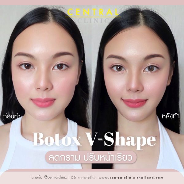 BOTOX Korea Premium 50 Units