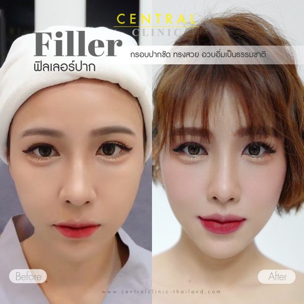 Filler Korea โปร 1 CC