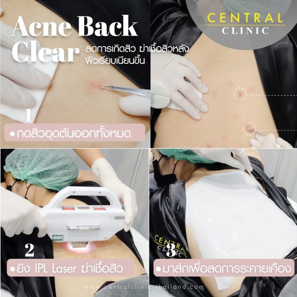 Acne Back Clear