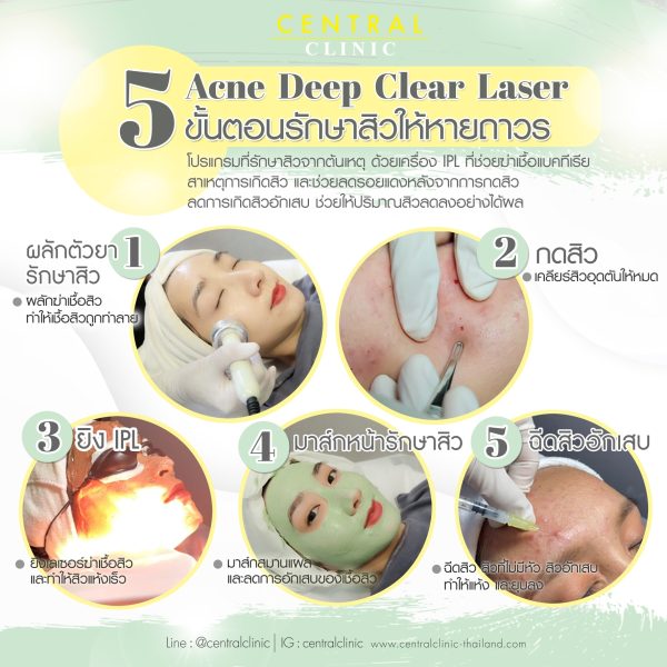 Acne Deep Clear